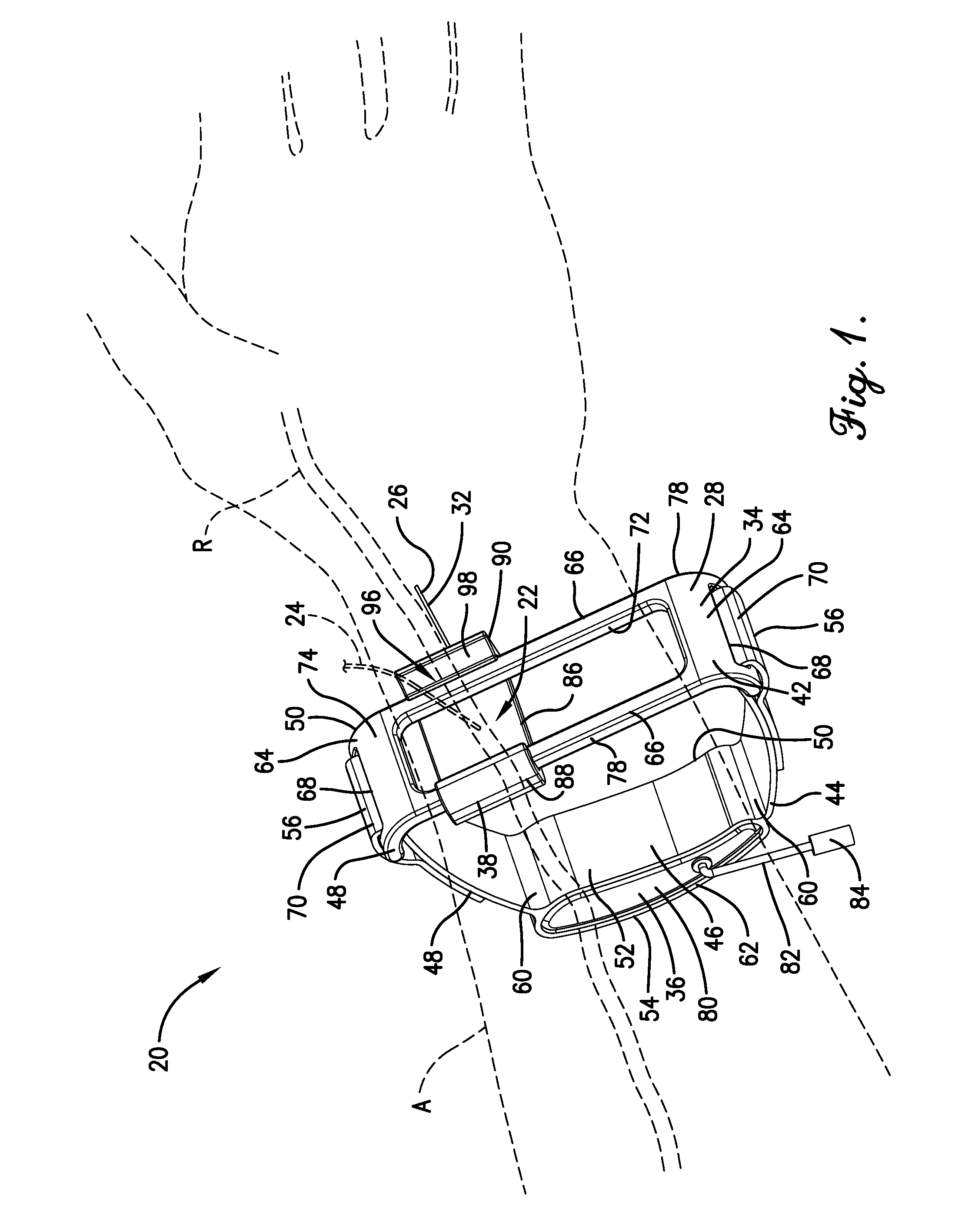 Radial compression hemostasis band with Doppler confirming vascular patency