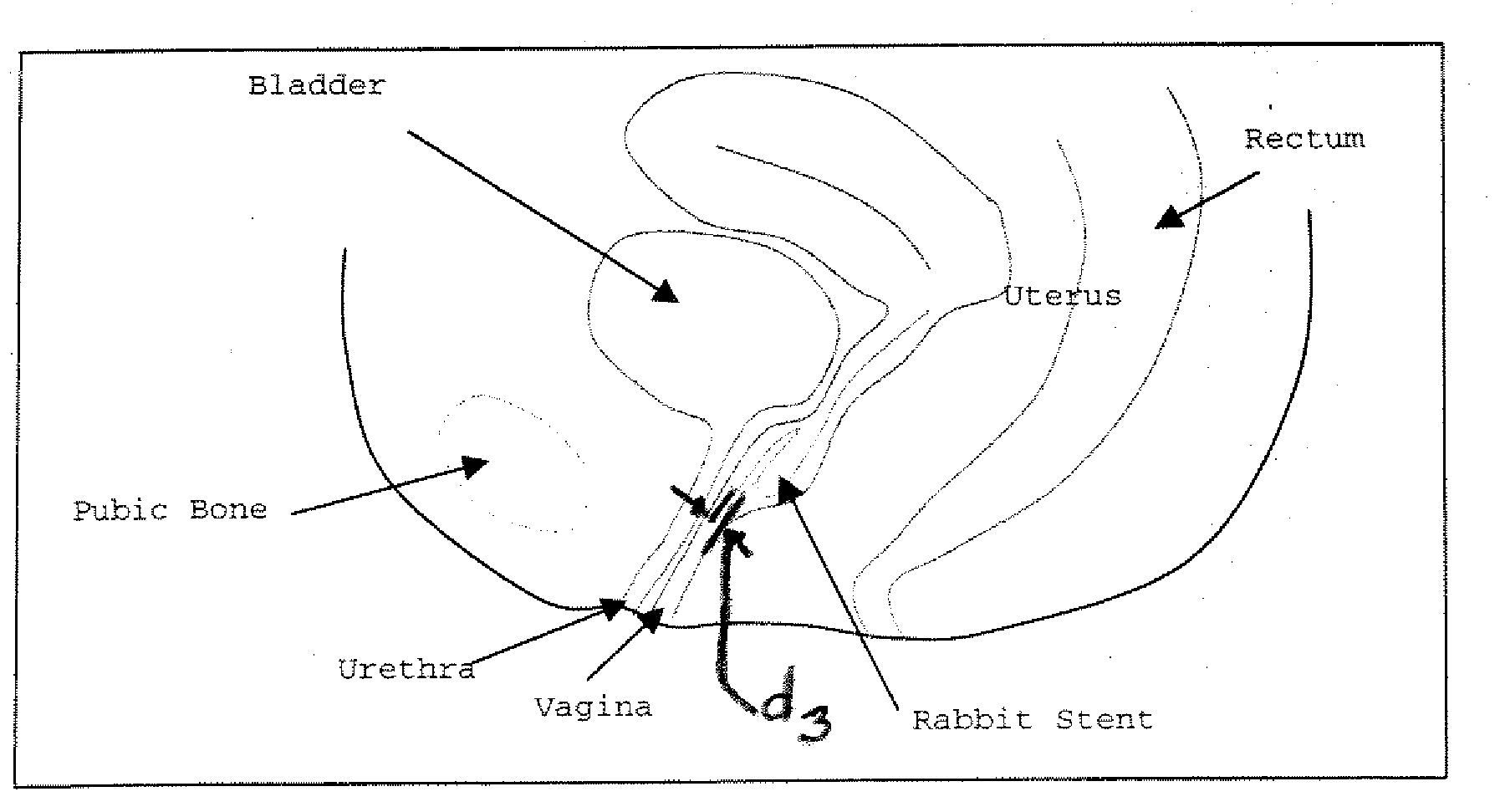 Method of treating urinary incontinence