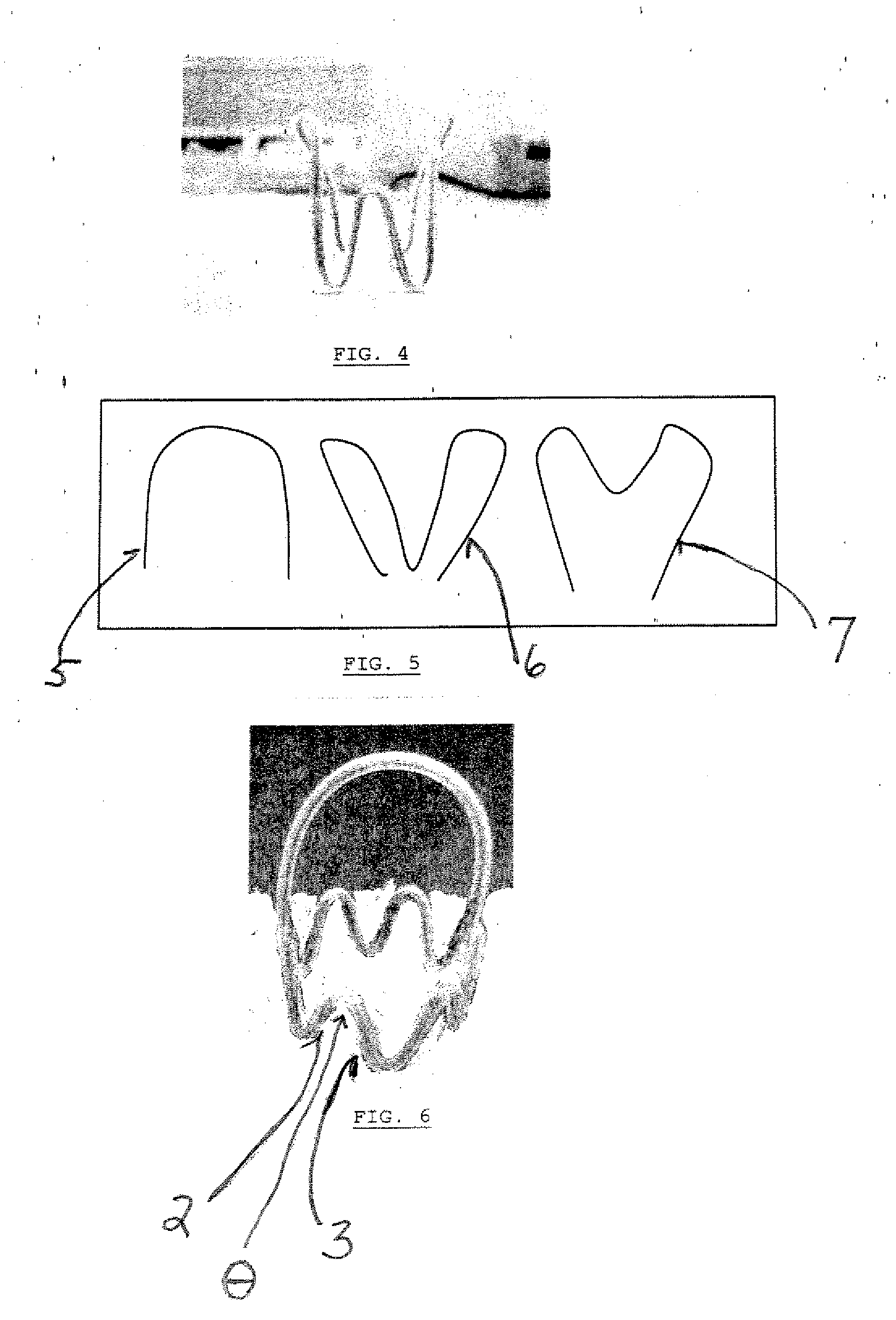 Method of treating urinary incontinence