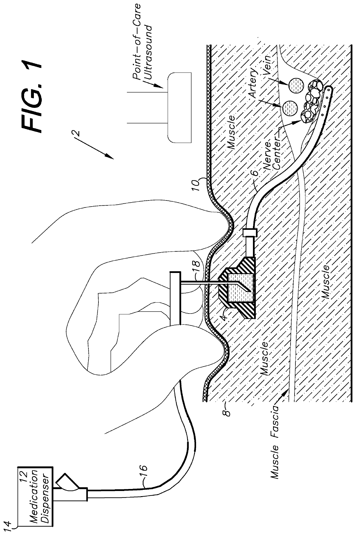 Catheter system with subcutaneous, implantable port and ultrasound-guided placement method