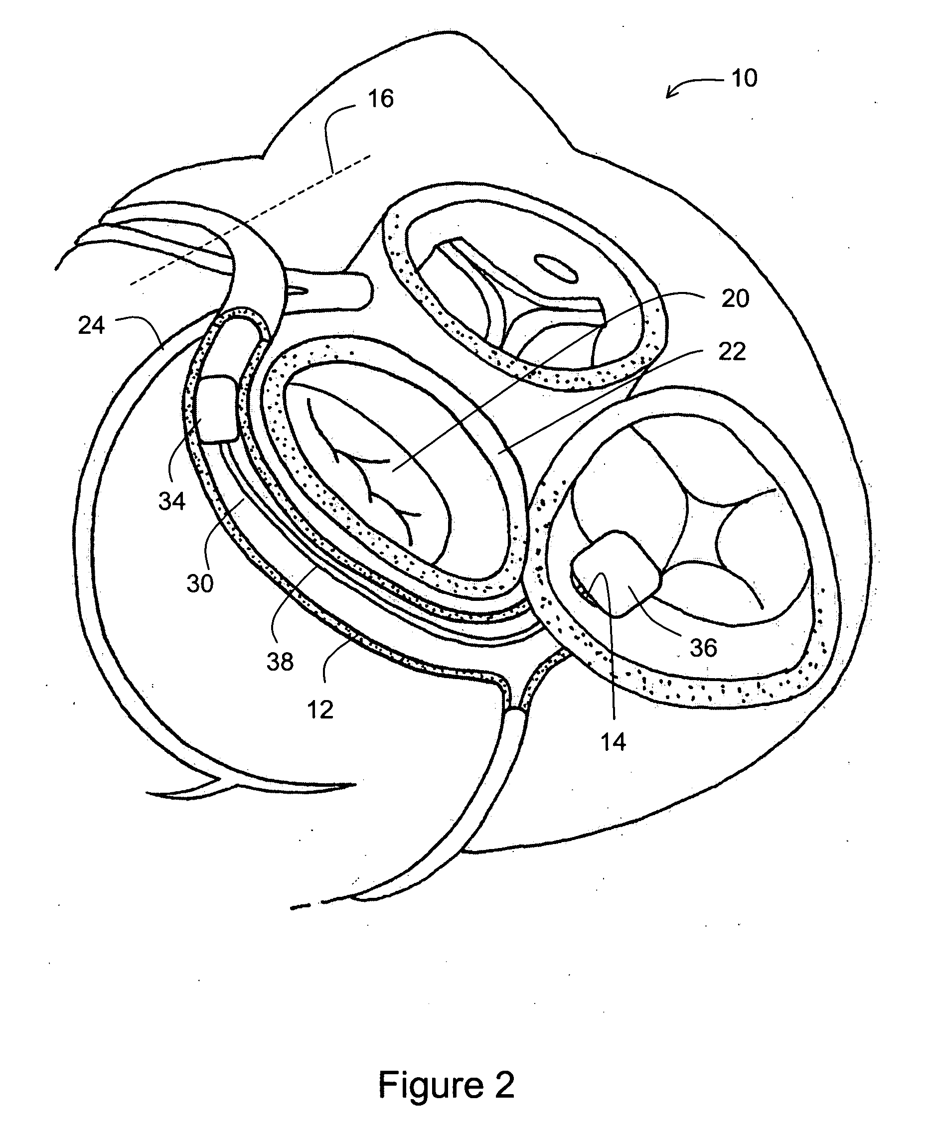 Tapered connector for tissue shaping device
