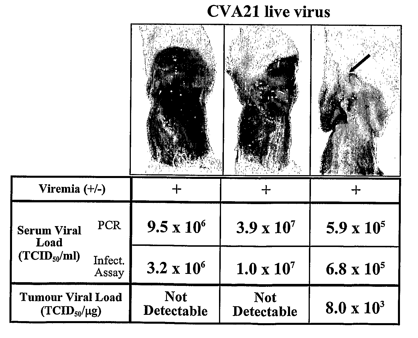 Method and Composition for Treatment of Neoplasms