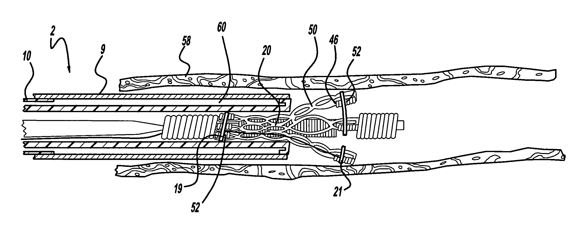 Self-expanding stent and stent delivery system for treatment of vascular disease