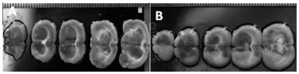 Application of combination of clostridium ghonii and tumor angiogenesis inhibitor