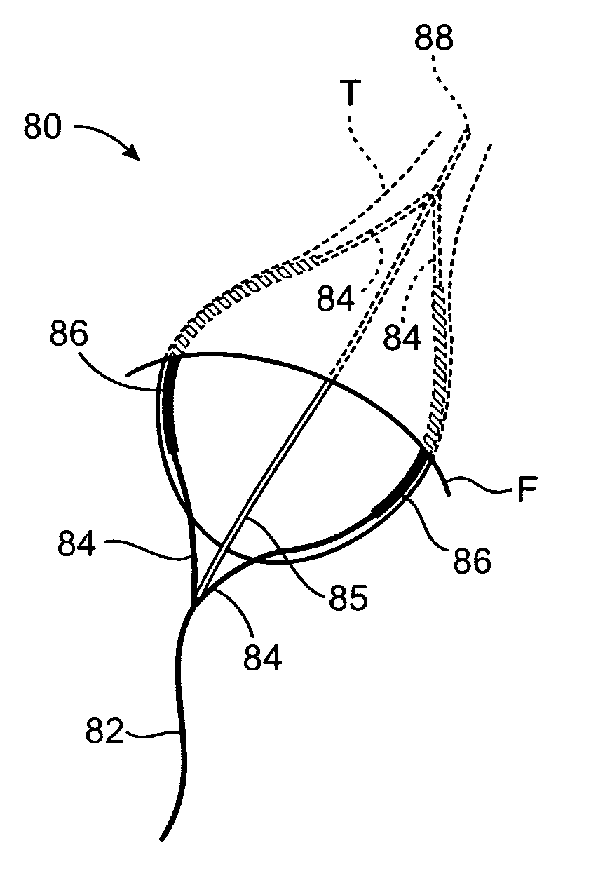 Methods and apparatus to achieve a closure of a layered tissue defect