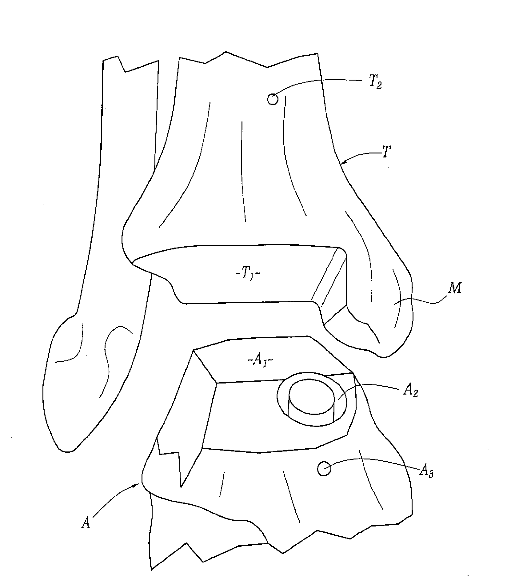 Surgical instrumentation kit for inserting an ankle prosthesis