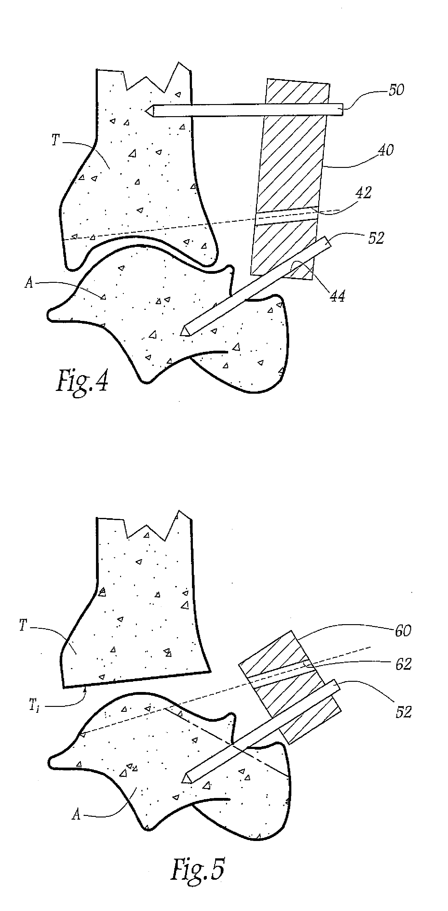 Surgical instrumentation kit for inserting an ankle prosthesis