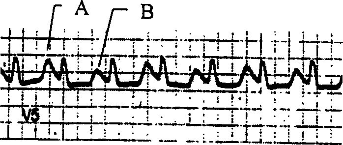 Alternating T-wave measuring method for sports electrocardiogram