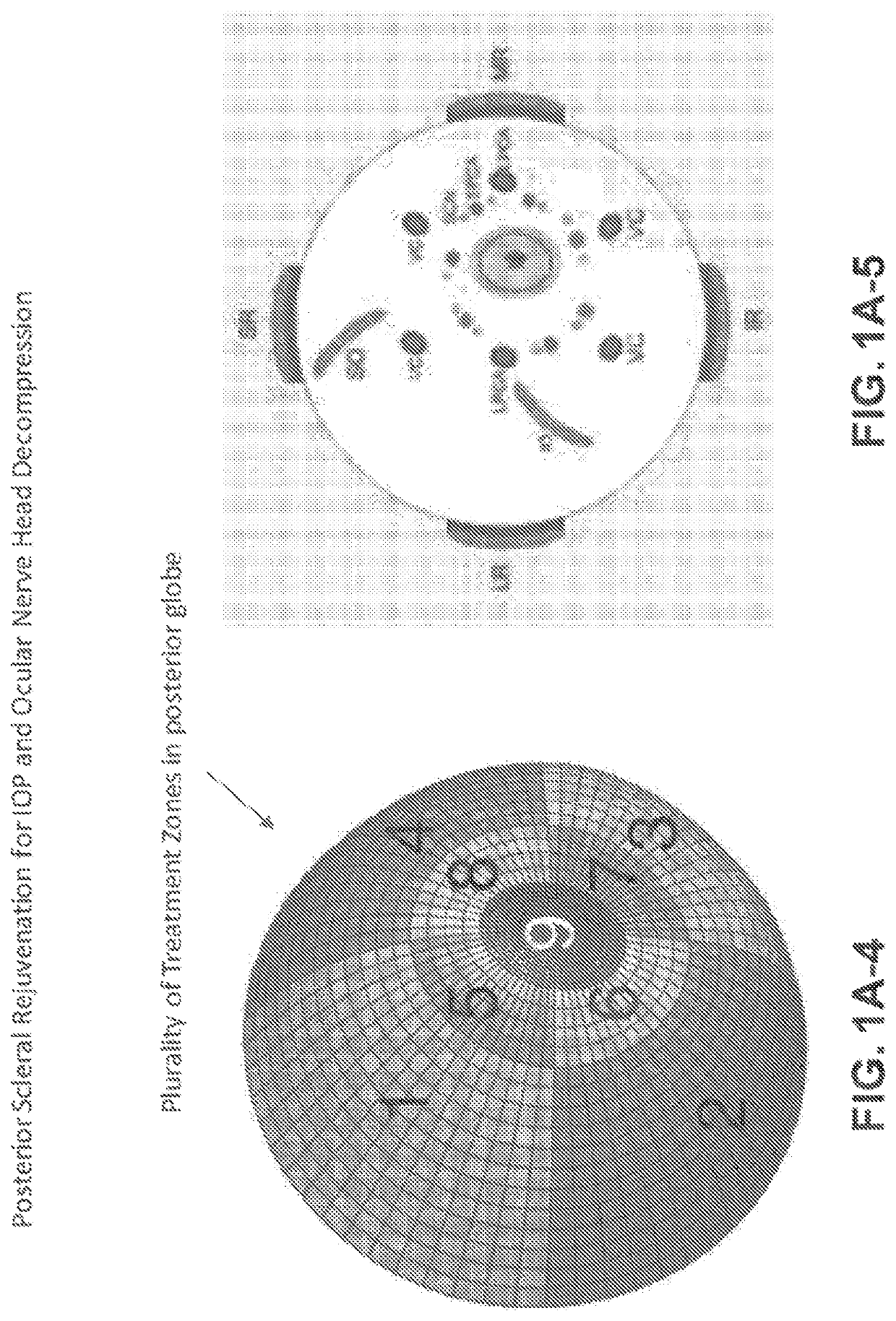 Systems and methods for ocular laser surgery and therapeutic treatments