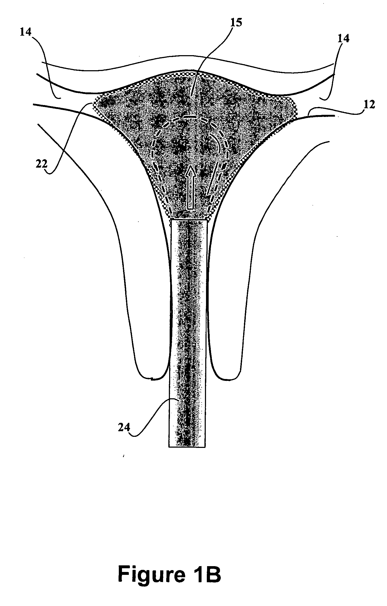 Dip-molded polymeric medical devices with reverse thickness gradient, and methood of making same