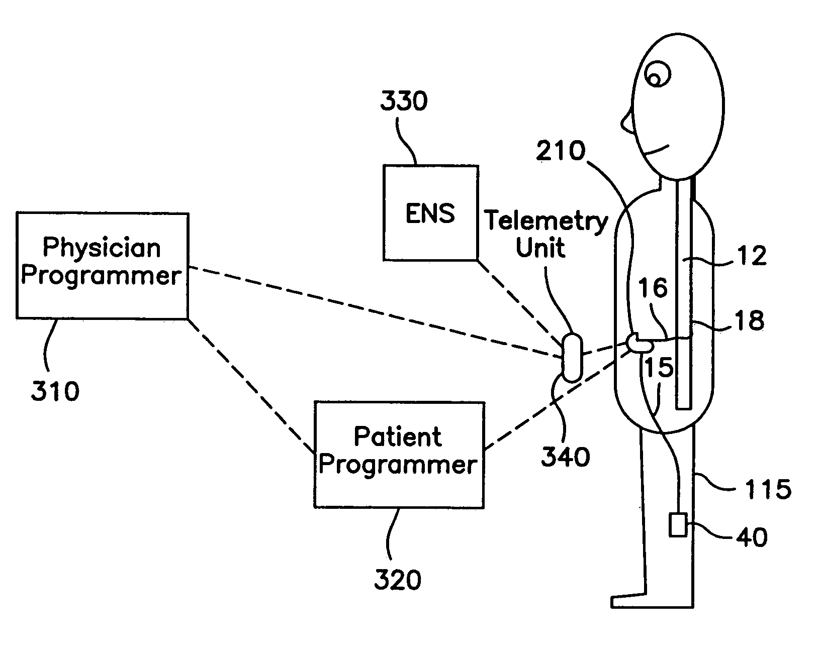 Method and apparatus for programming an implantable medical device