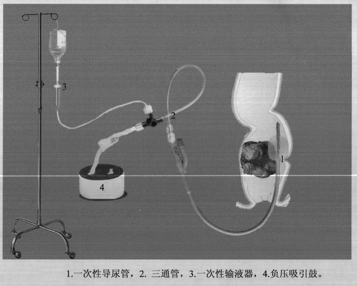 Defecating apparatus for removing intestinal obstruction