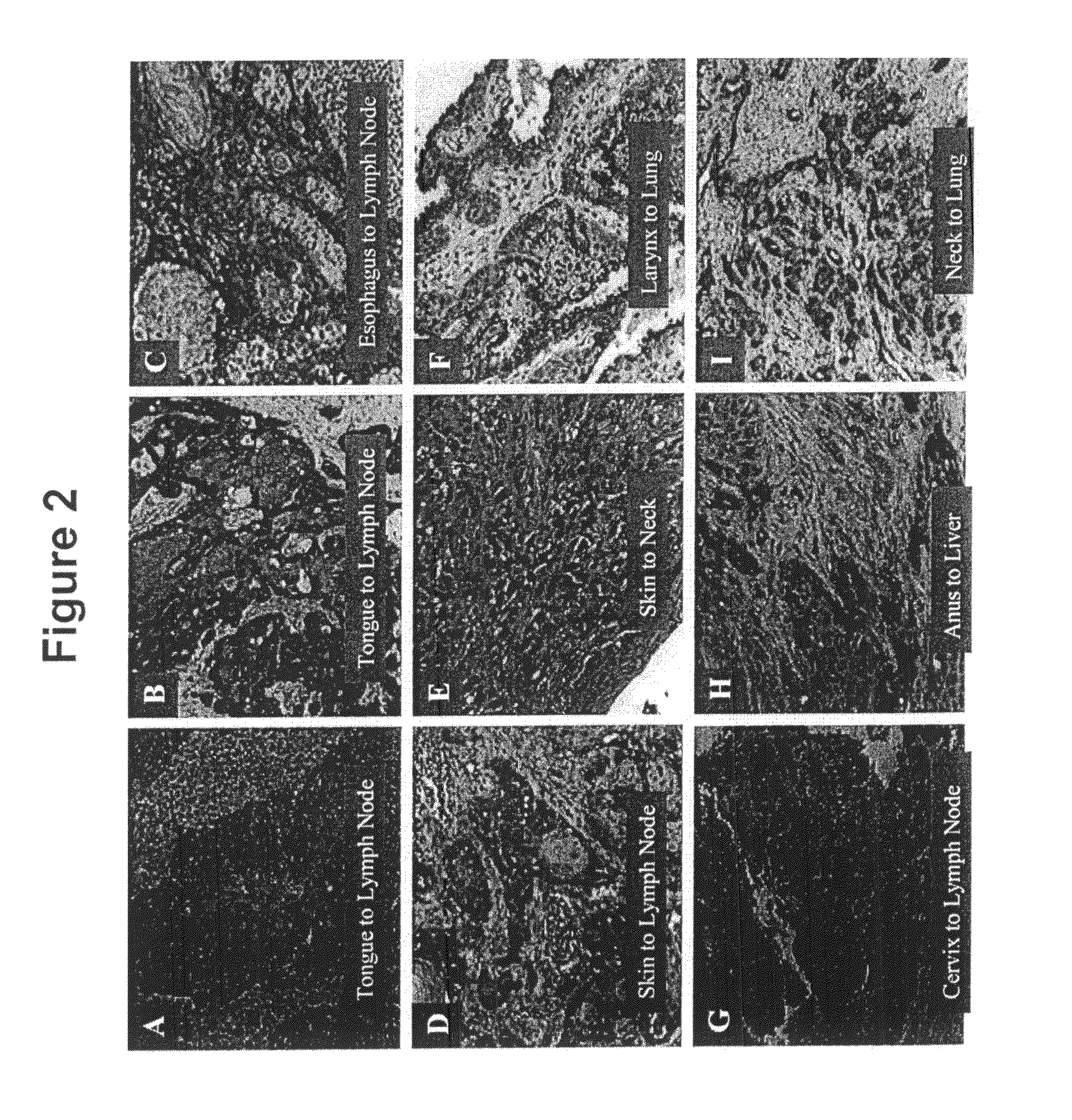 Compositions and methods for inhibiting growth of smad4-deficient cancers