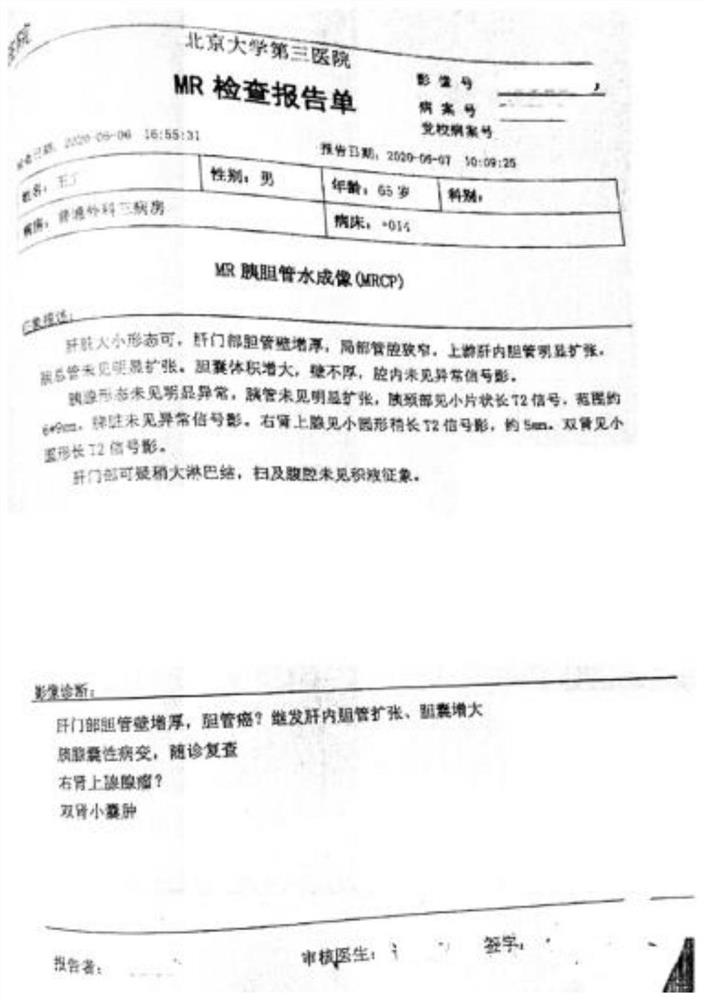 Traditional Chinese medicine composition for treating postoperative hepatic cholangiocarcinoma and cancerometastasis