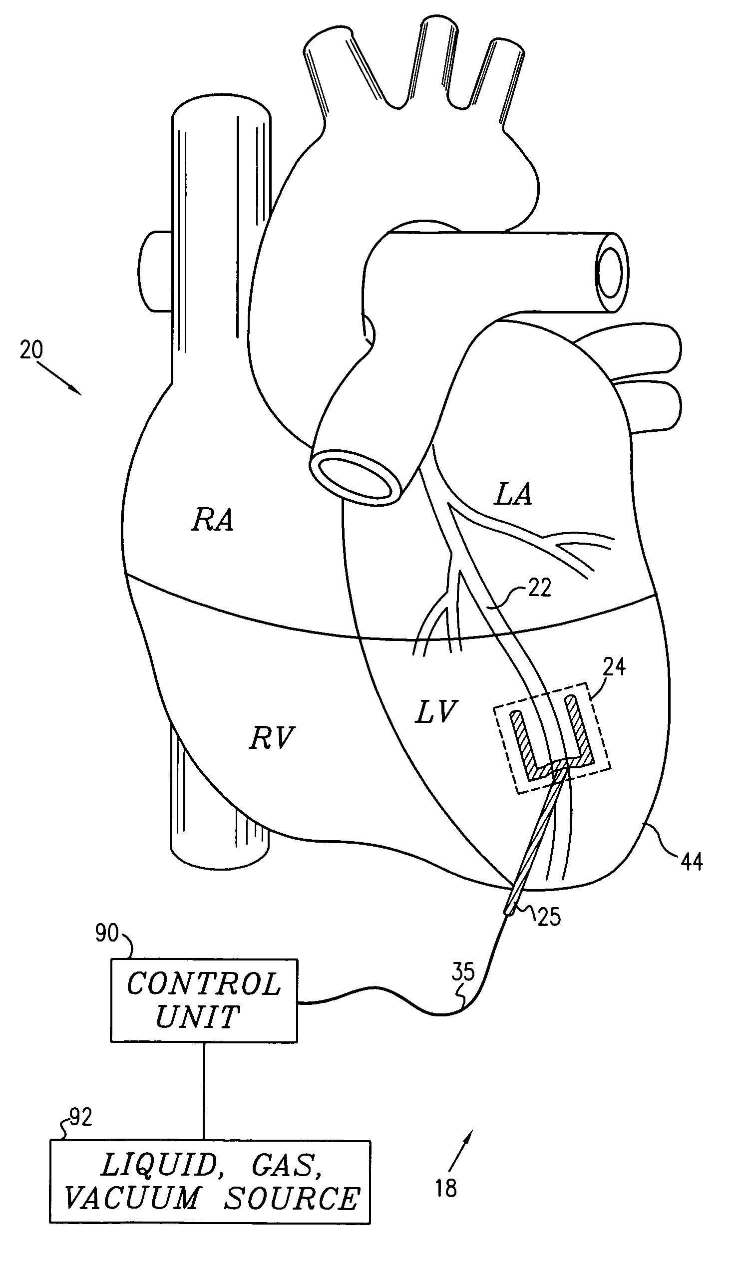 Local cardiac motion control using applied electrical signals and mechanical force