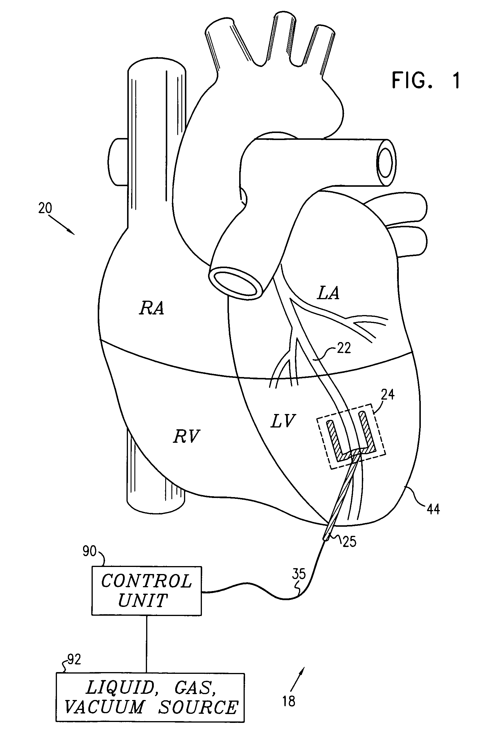 Local cardiac motion control using applied electrical signals and mechanical force