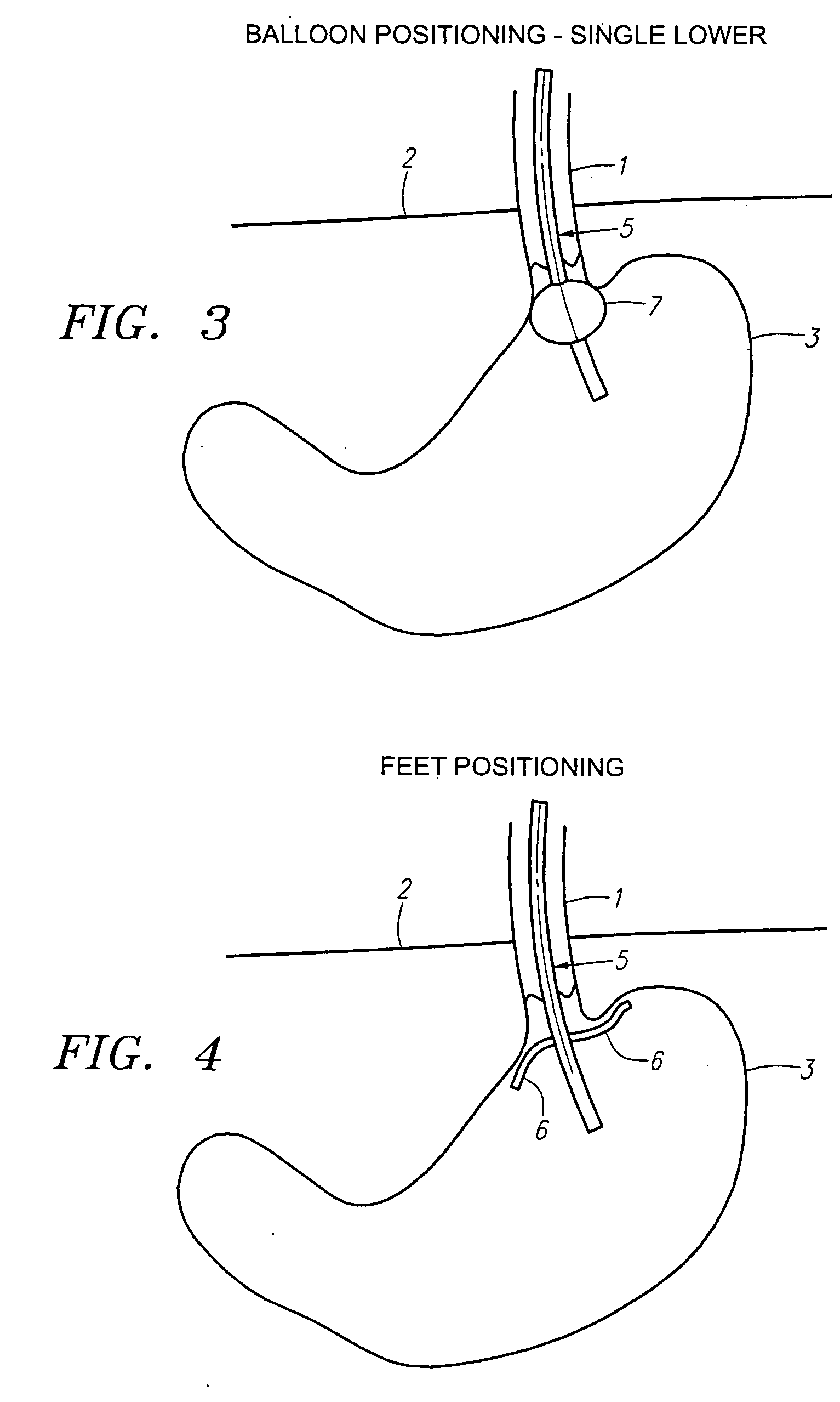 Method of using endoscopic truncal vagoscopy with gastric bypass, gastric banding and other procedures