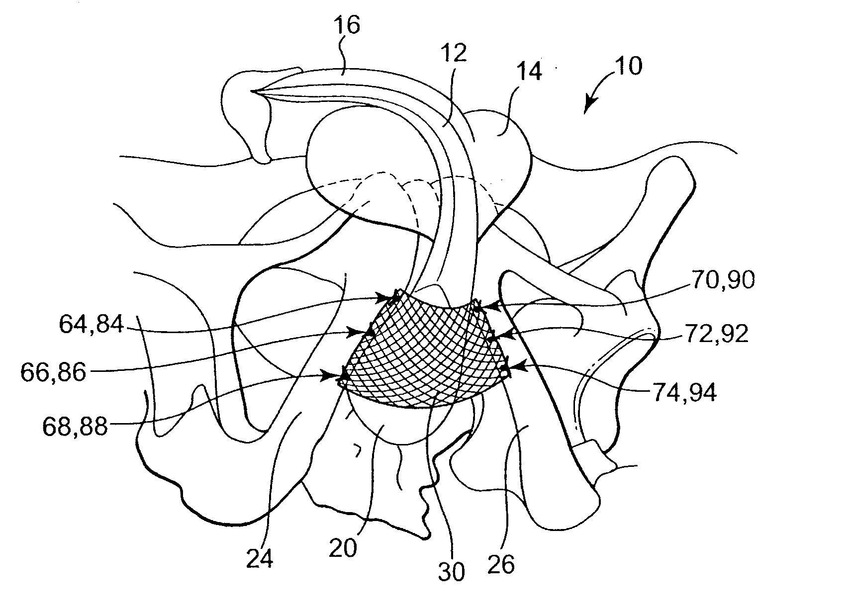 Methods and Apparatus for Securing and Tensioning a Urethral Sling to Pubic Bone