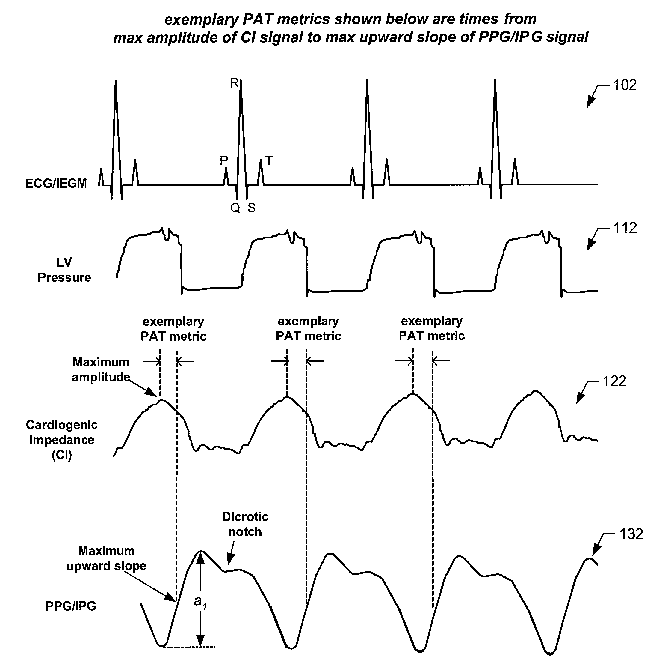 Arterial blood pressure monitoring devices, systems and methods using cardiogenic impedance signal