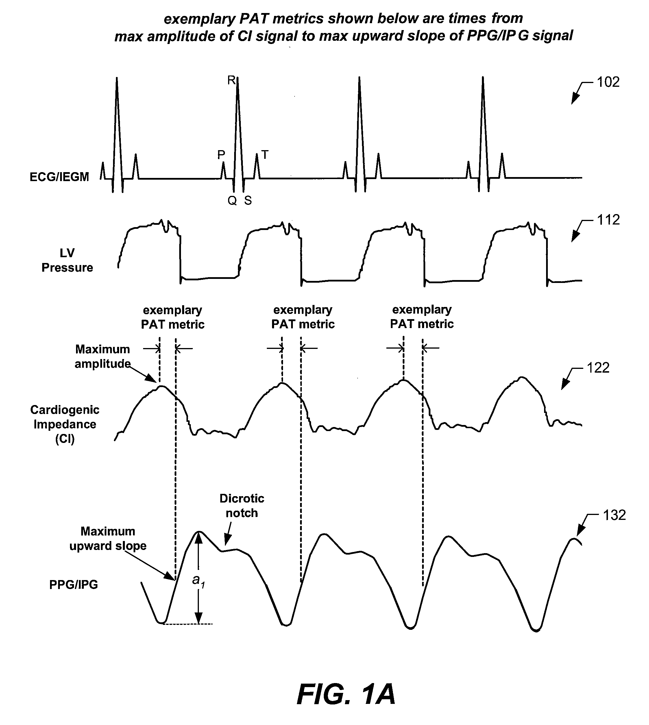 Arterial blood pressure monitoring devices, systems and methods using cardiogenic impedance signal