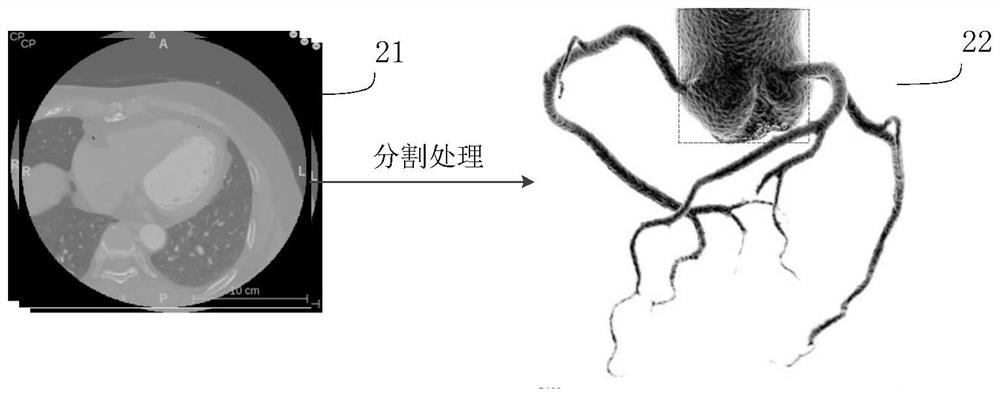Coronary artery calcified plaque detection method and device