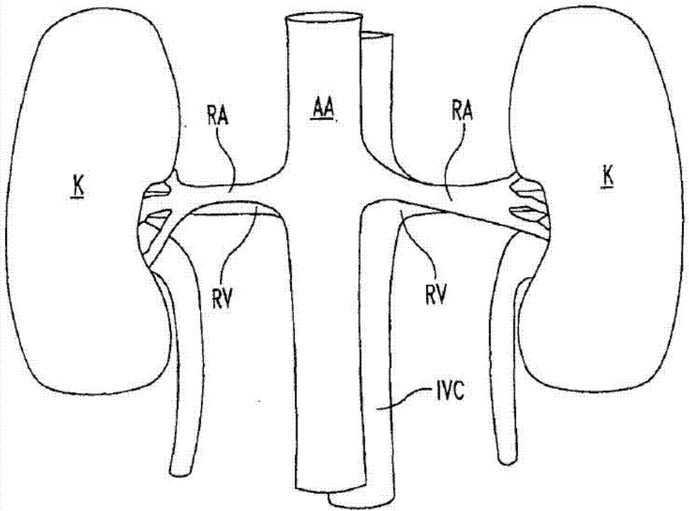 Multi-electrode renal artery radio-frequency ablation catheter