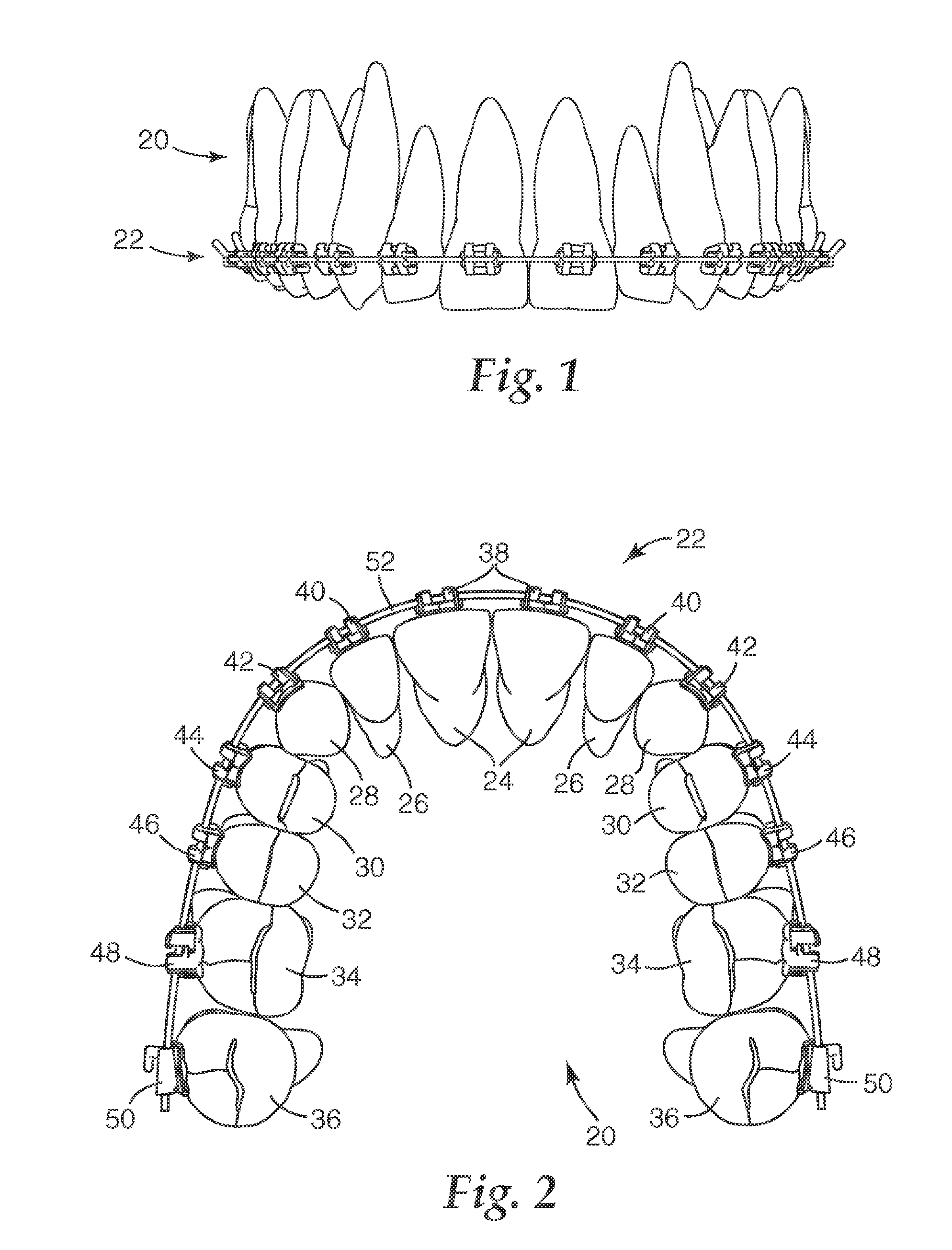 Molar appliance for an orthodontic brace