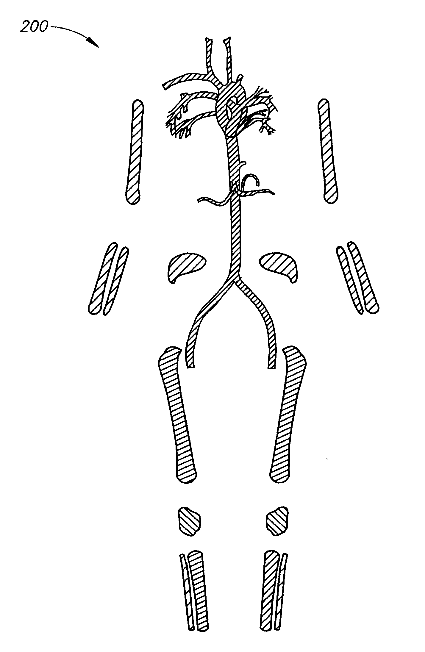 Bone segmentation