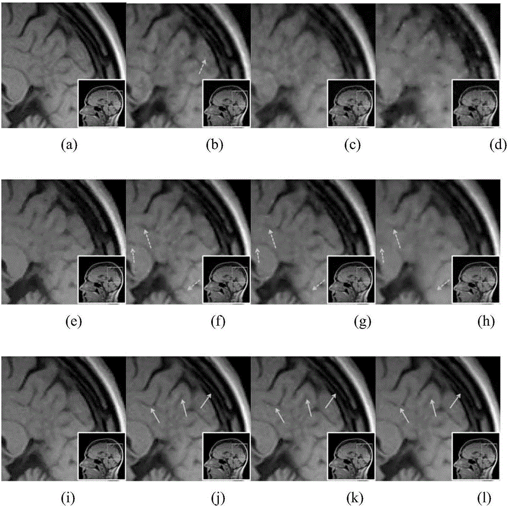 Fast iterative magnetic resonance image reconstruction method based on high-order total variation regularization