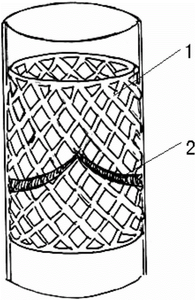 Degradable bioprosthetic valve system which is implanted in high elasticity external stent through conduit, preparation thereof and application thereof