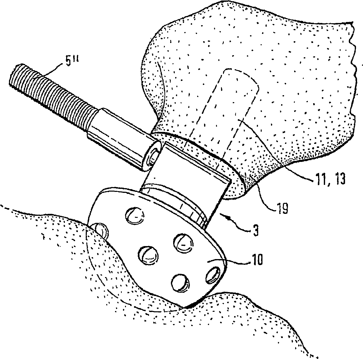 Surgical appliance for milling acetabulum