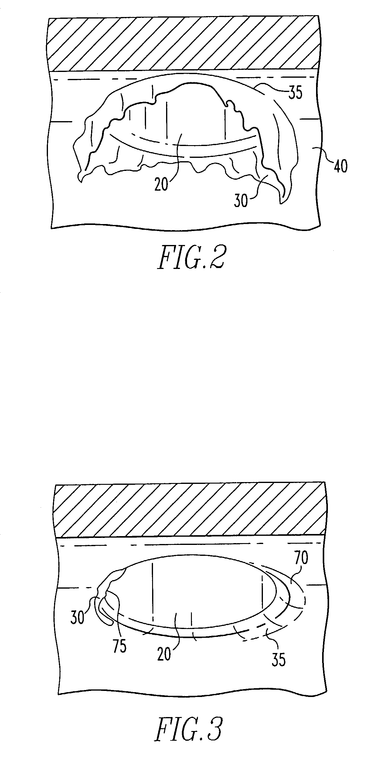 Method and apparatus for abrading the region of intersection between a branch outlet and a passageway in a body