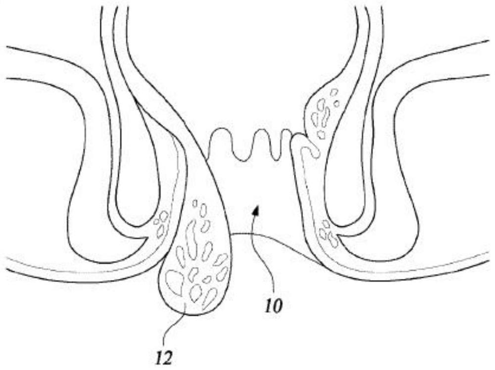 Banana clip for removing hemorrhoids, and surgical tool set including same