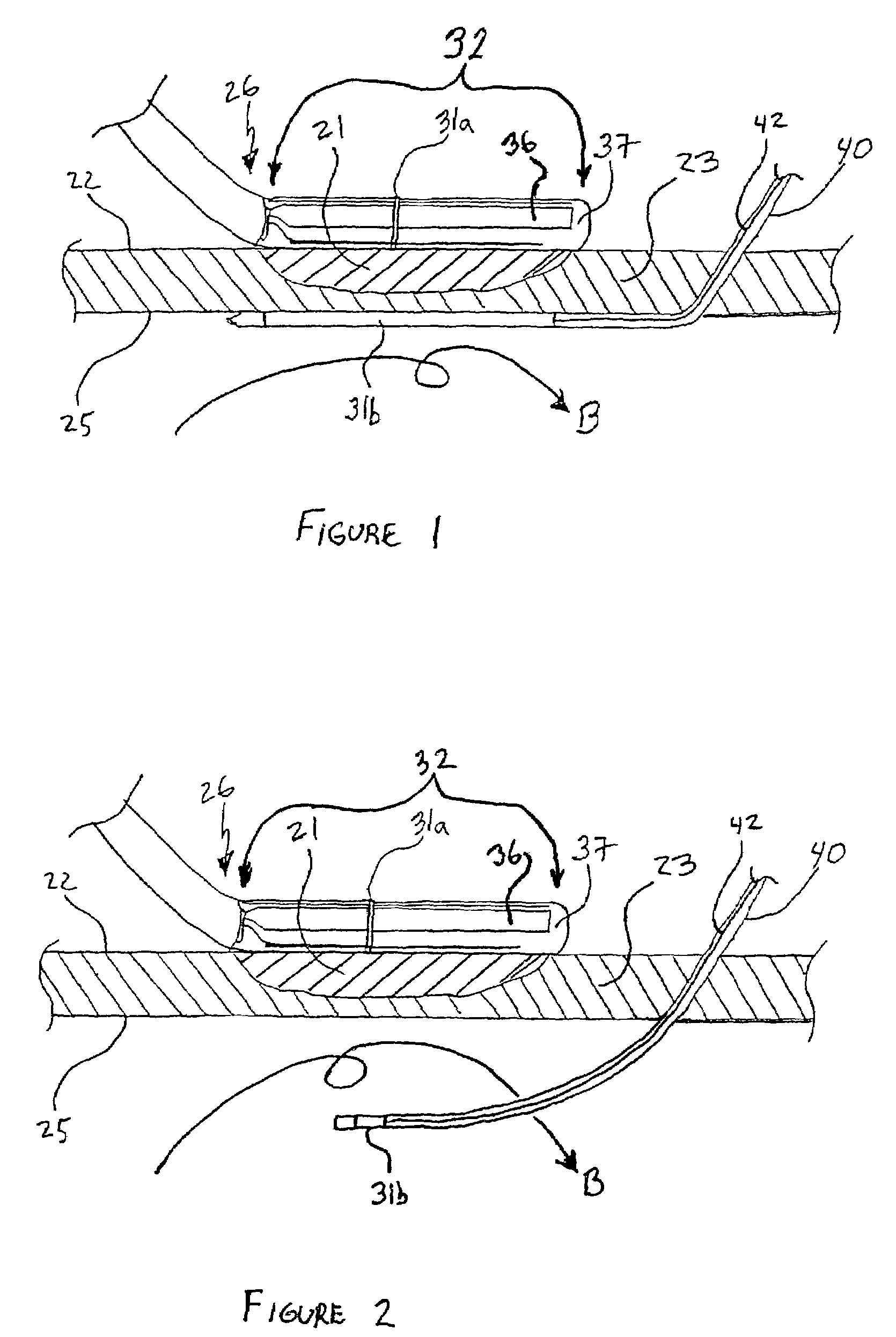 Apparatus and method for assessing transmurality of a tissue ablation