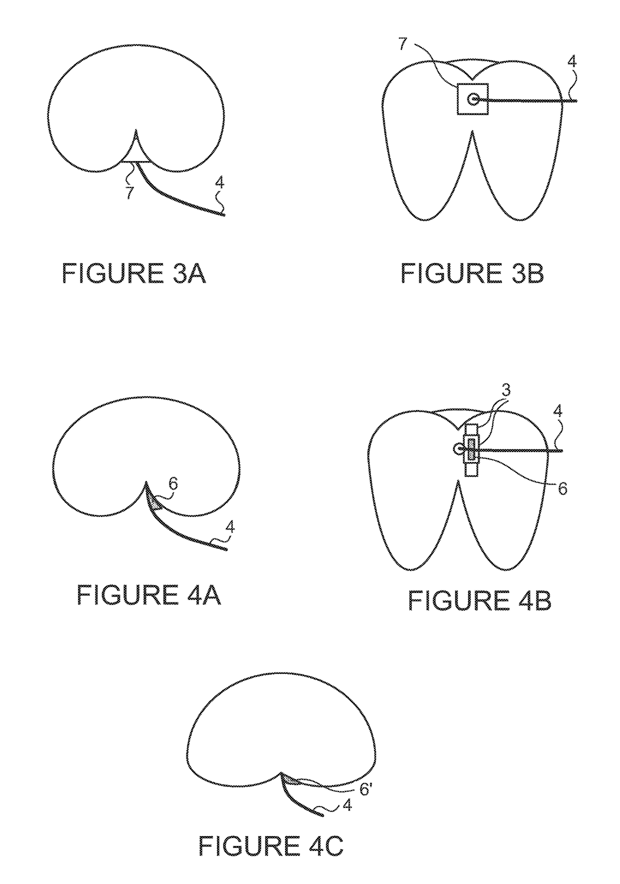 Anal fixation device