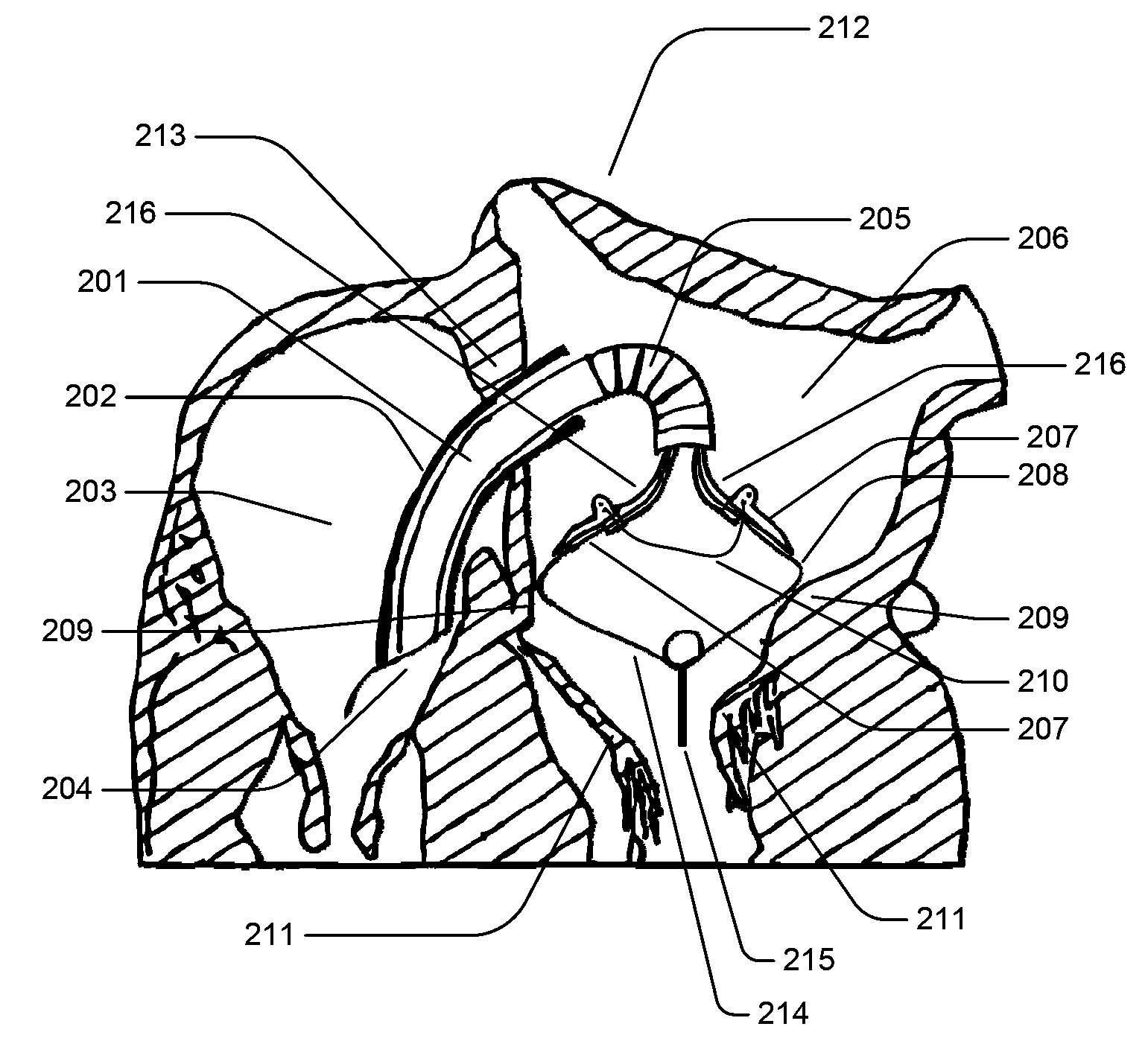 Medical Device for Constricting Tissue or a Bodily Orifice, for example a mitral valve
