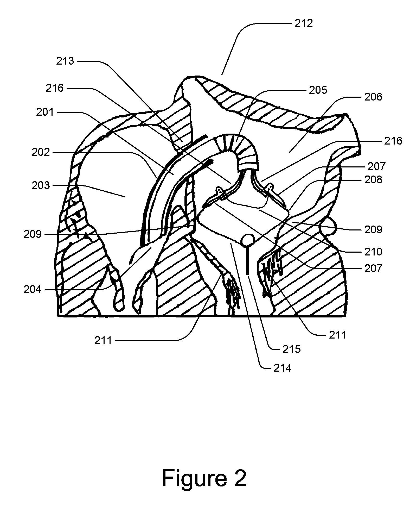 Medical Device for Constricting Tissue or a Bodily Orifice, for example a mitral valve