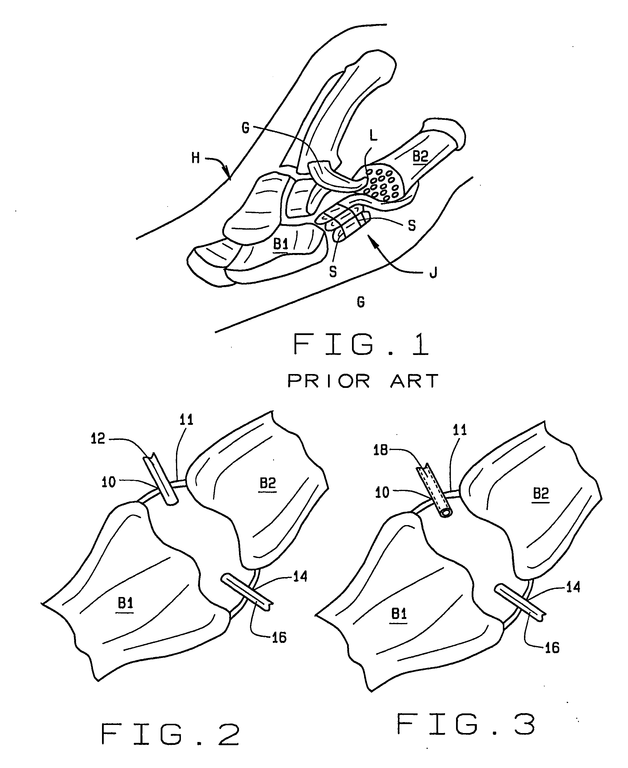 Arthoscopic arthroplasty procedure for the repair or reconstruction of arthritic joints