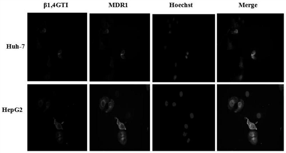 Application of beta-1, 4-galactosyltransferase-IsiRNA in drugs for overcoming liver cancer chemotherapy drug resistance