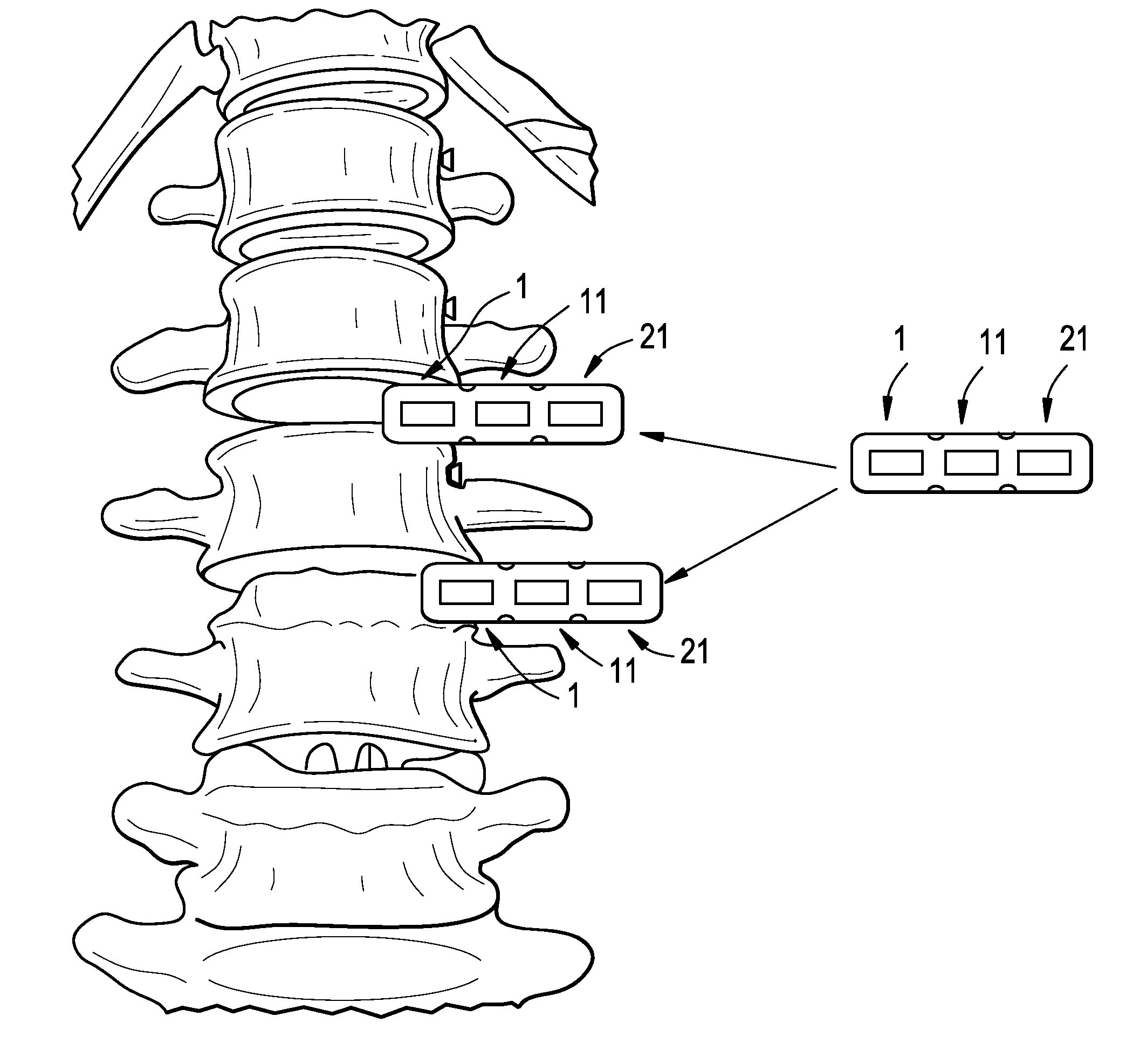 Multi-Segment Lateral Cage Adapted to Flex Substantially in the Coronal Plane