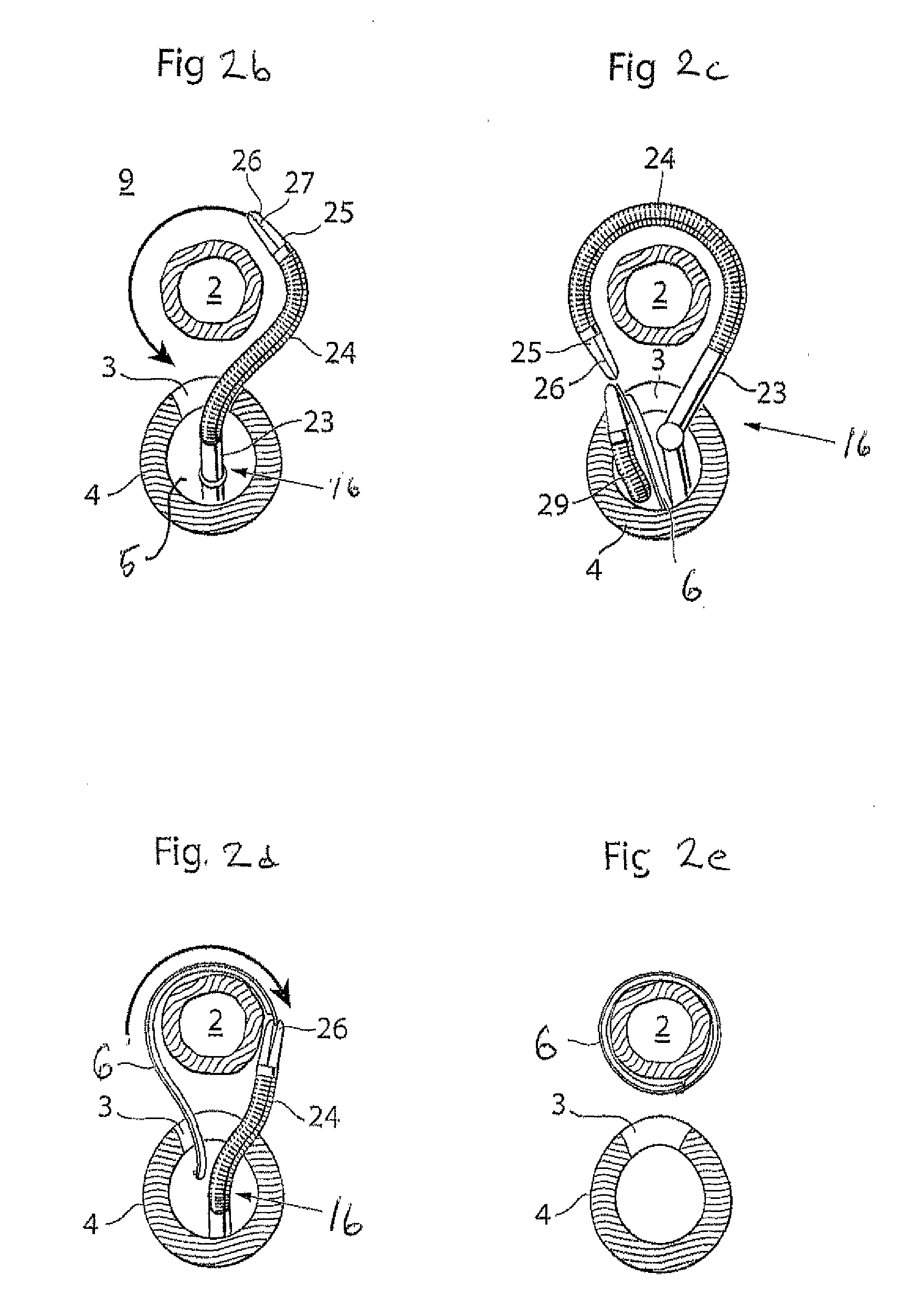 Vaginal operation method for the treatment of urinary incontinence in women
