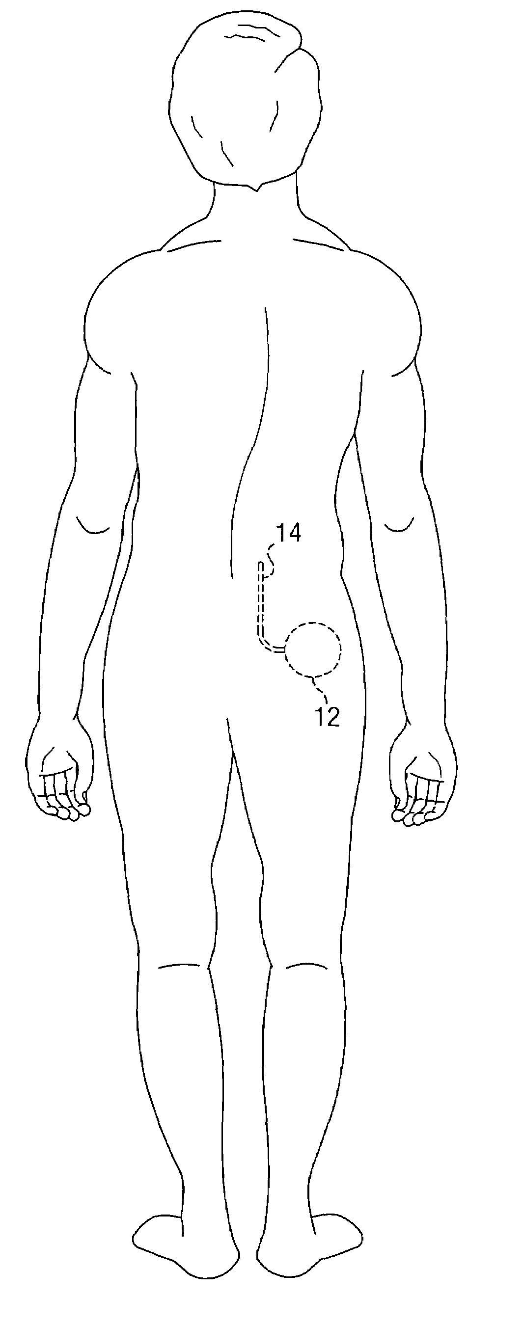 System and method for neurological stimulation of peripheral nerves to treat low back pain