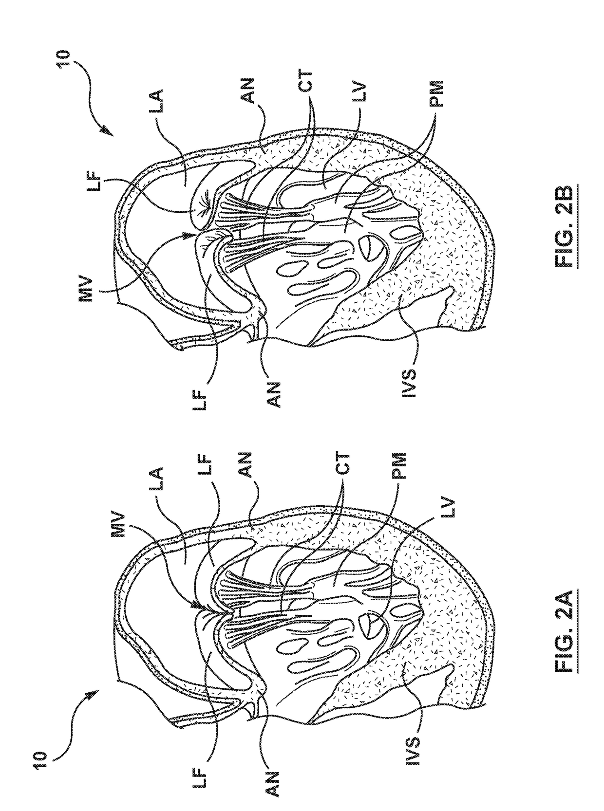 Heart valve prostheses having multiple support arms and methods for percutaneous heart valve replacement
