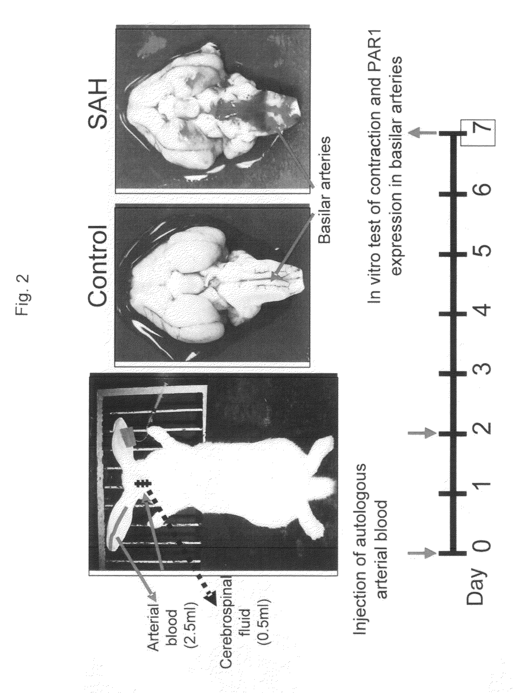 Remedy for angiospasm accompanying subarachnoid hemorrhage containing thrombin receptor antagonist as the active ingredient