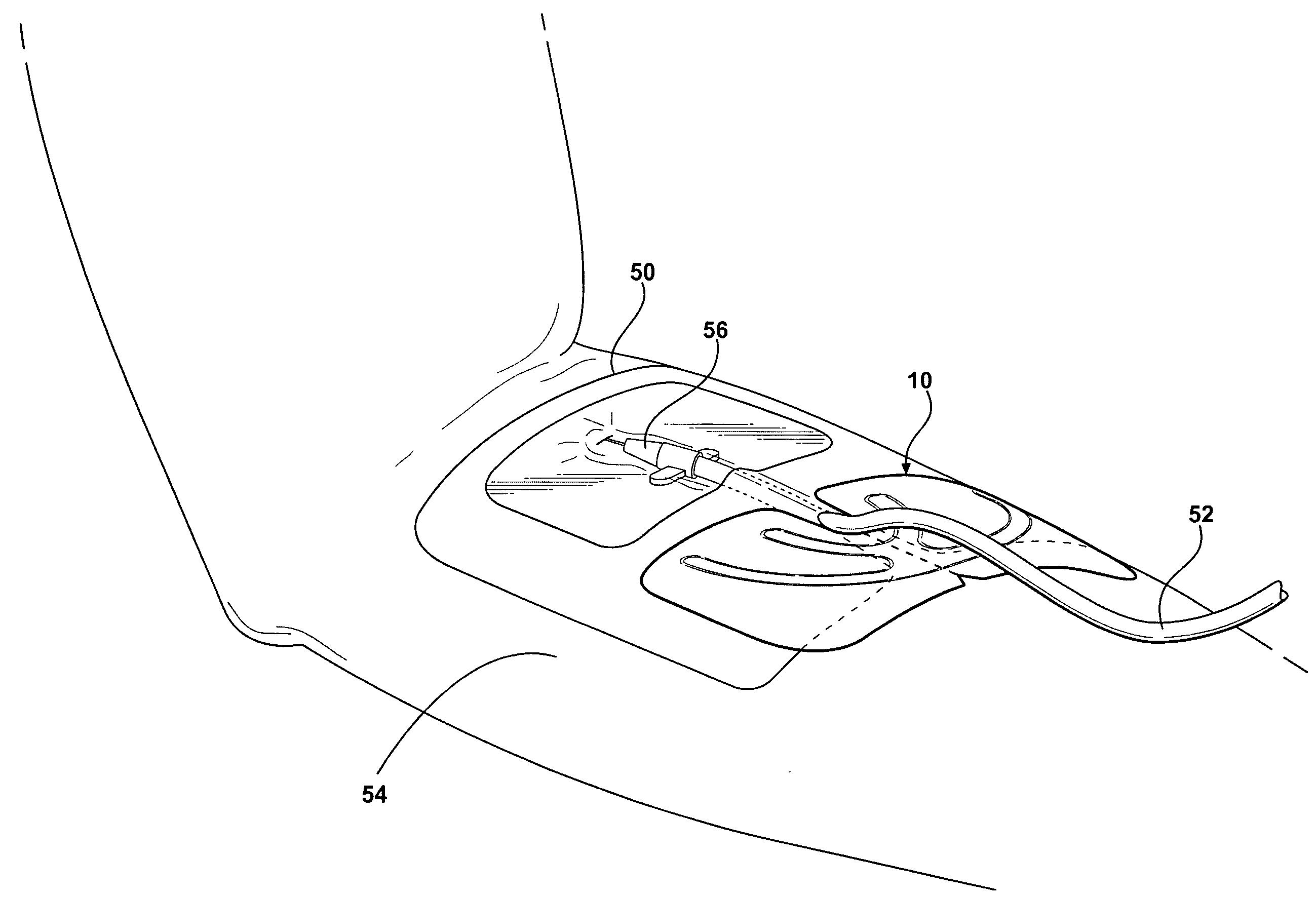 Reinforced closure anchor