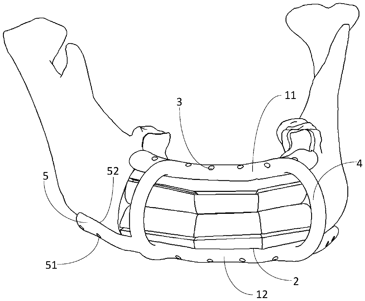 In-position guide plate applied to multi-segment fibula double-stack reconstruction of mandible