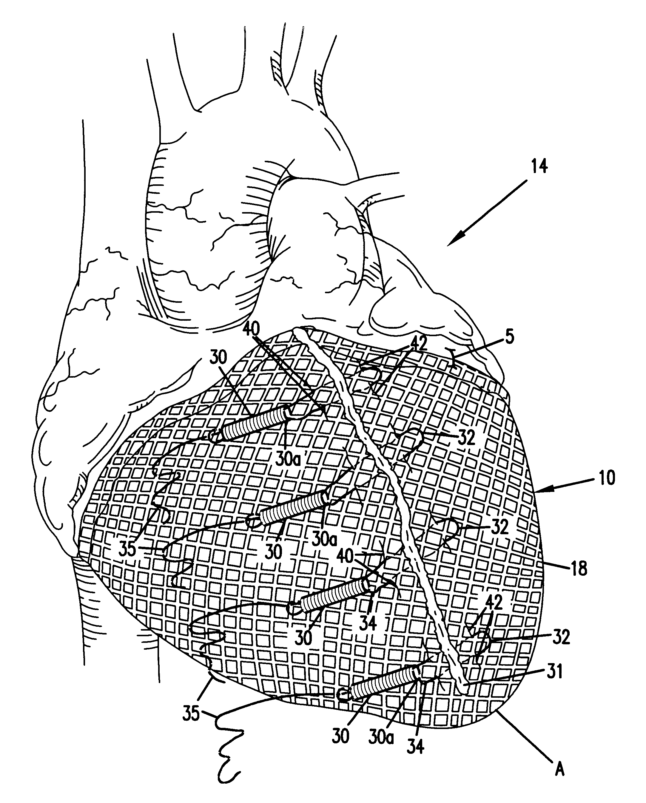 Cardiac constraint with draw string tensioning