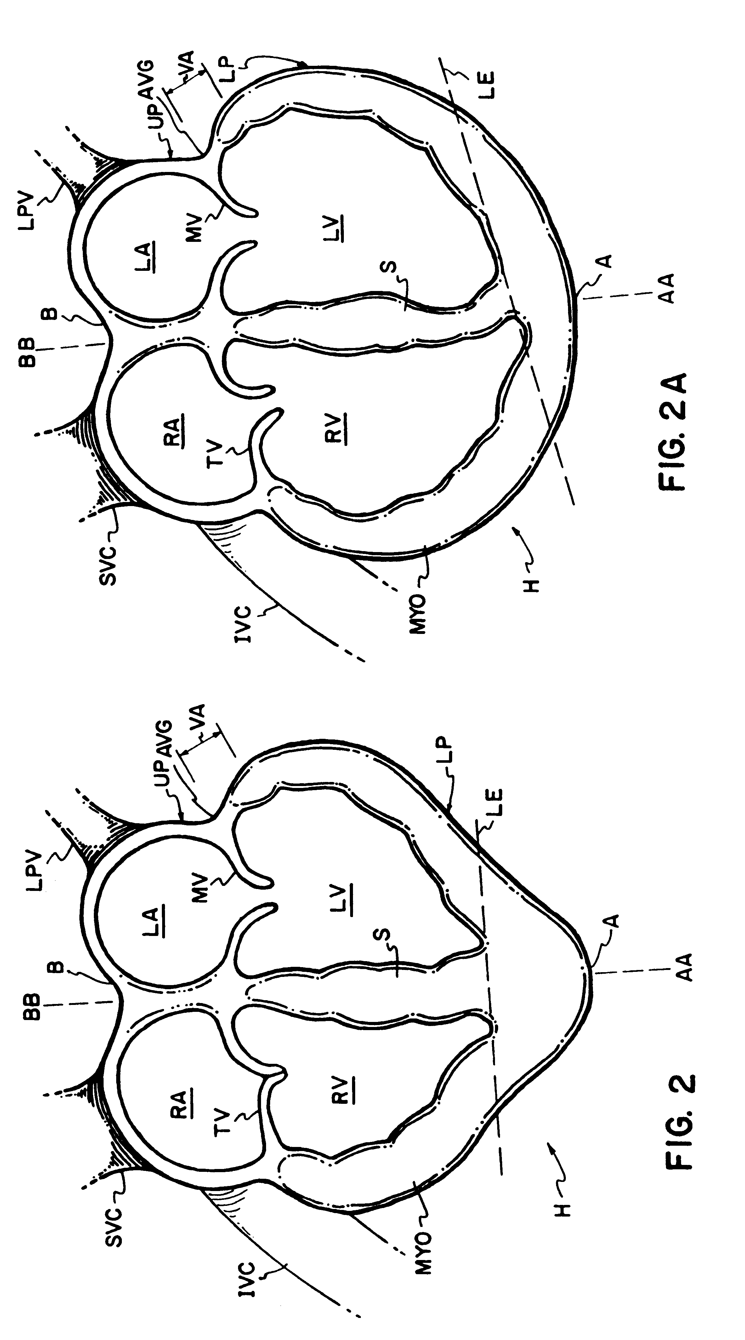 Cardiac constraint with draw string tensioning