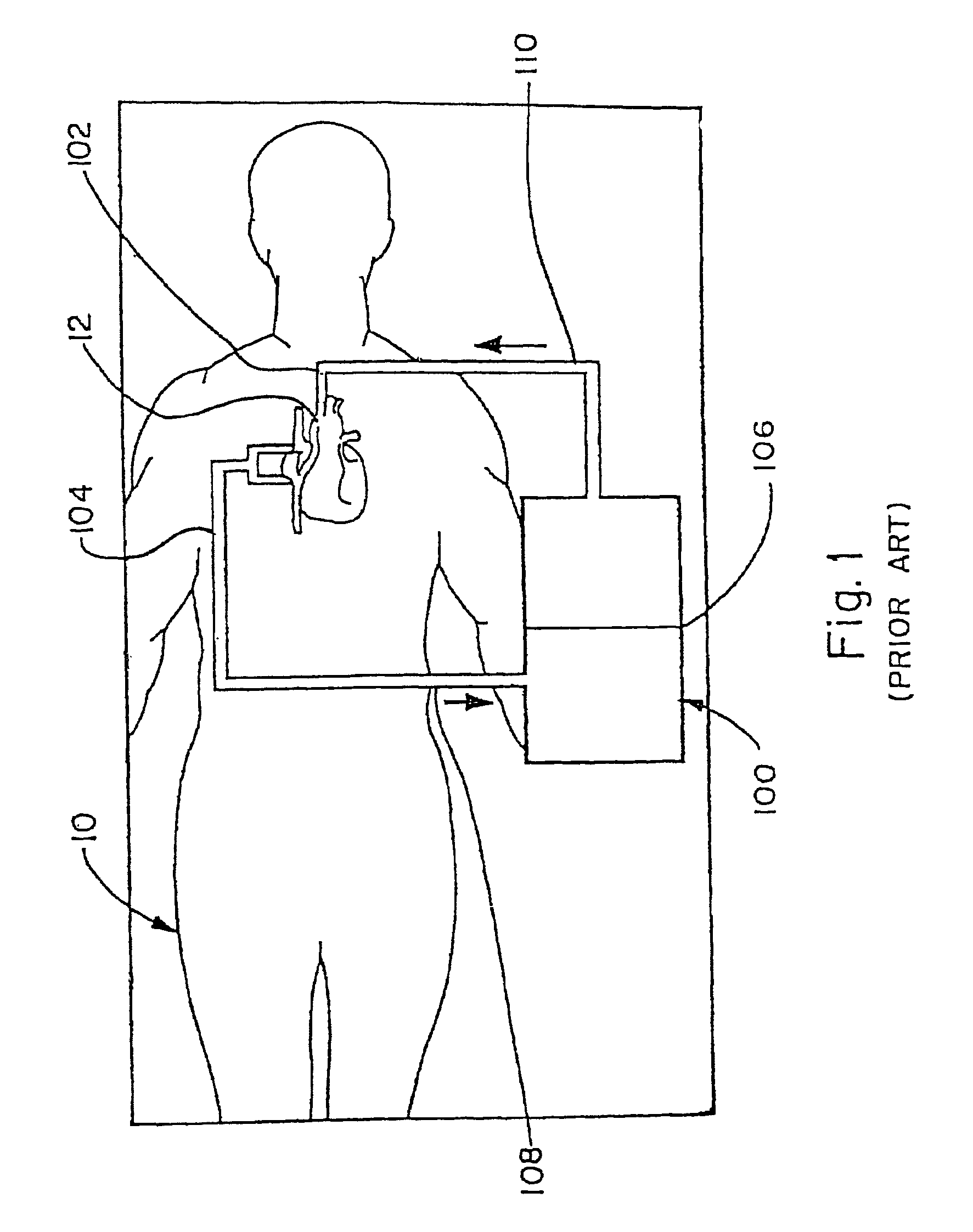 CPB system with fluid volume control