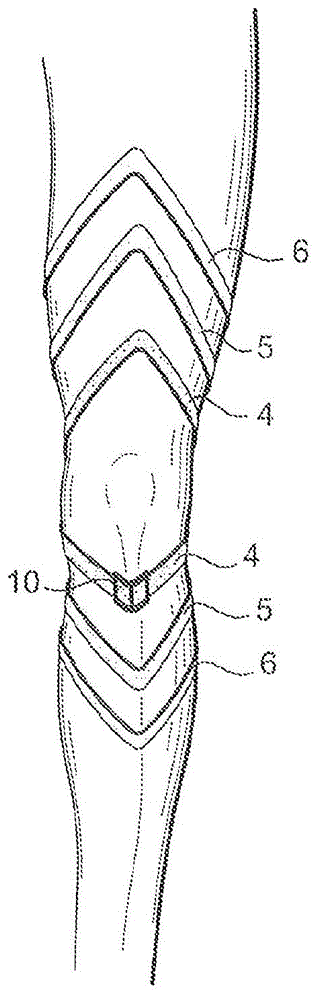 Knee orthosis for torn anterior cruciate ligament